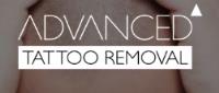 Advanced Tattoo Removal Gold Coast image 1